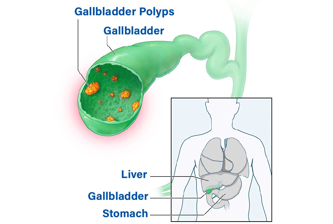 gallbladder_polyps_for_gallbladder_removal_in_turkey