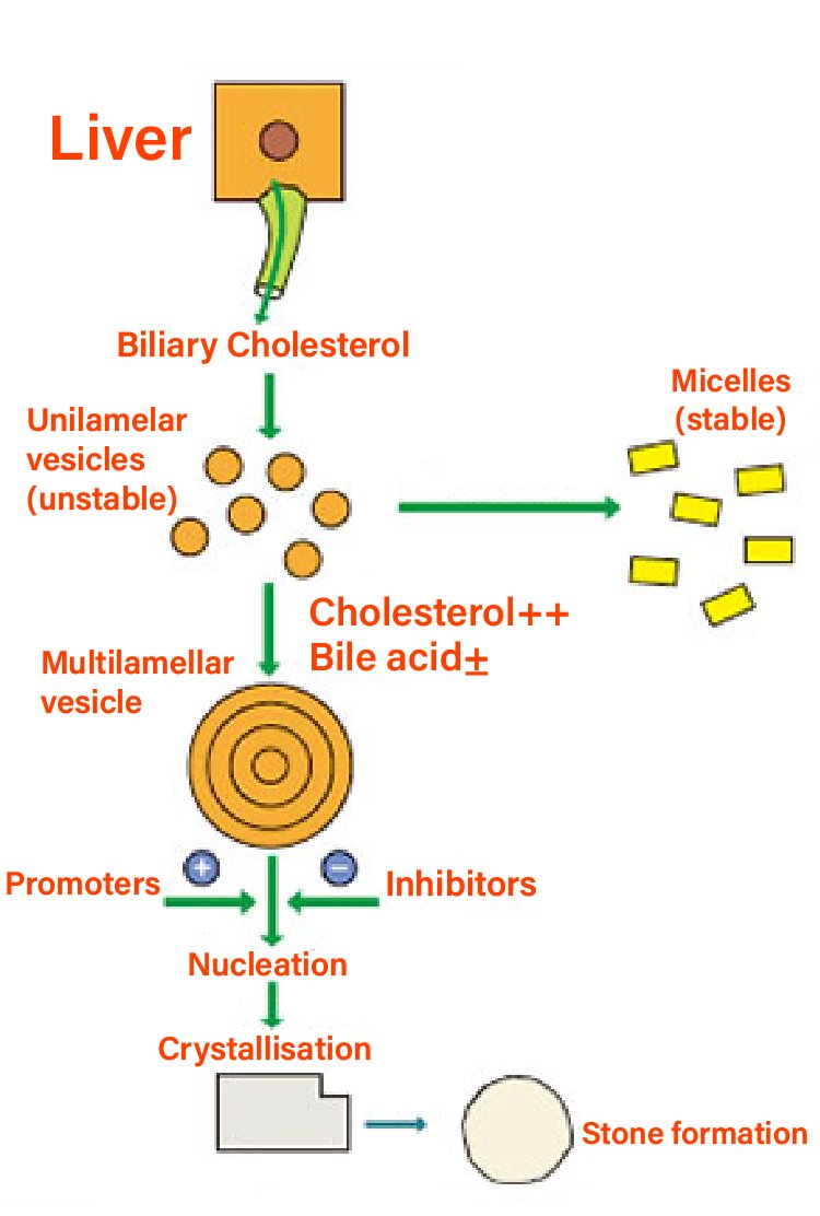 gallstone_format_on_for_gallbladder_removal_in_turkey