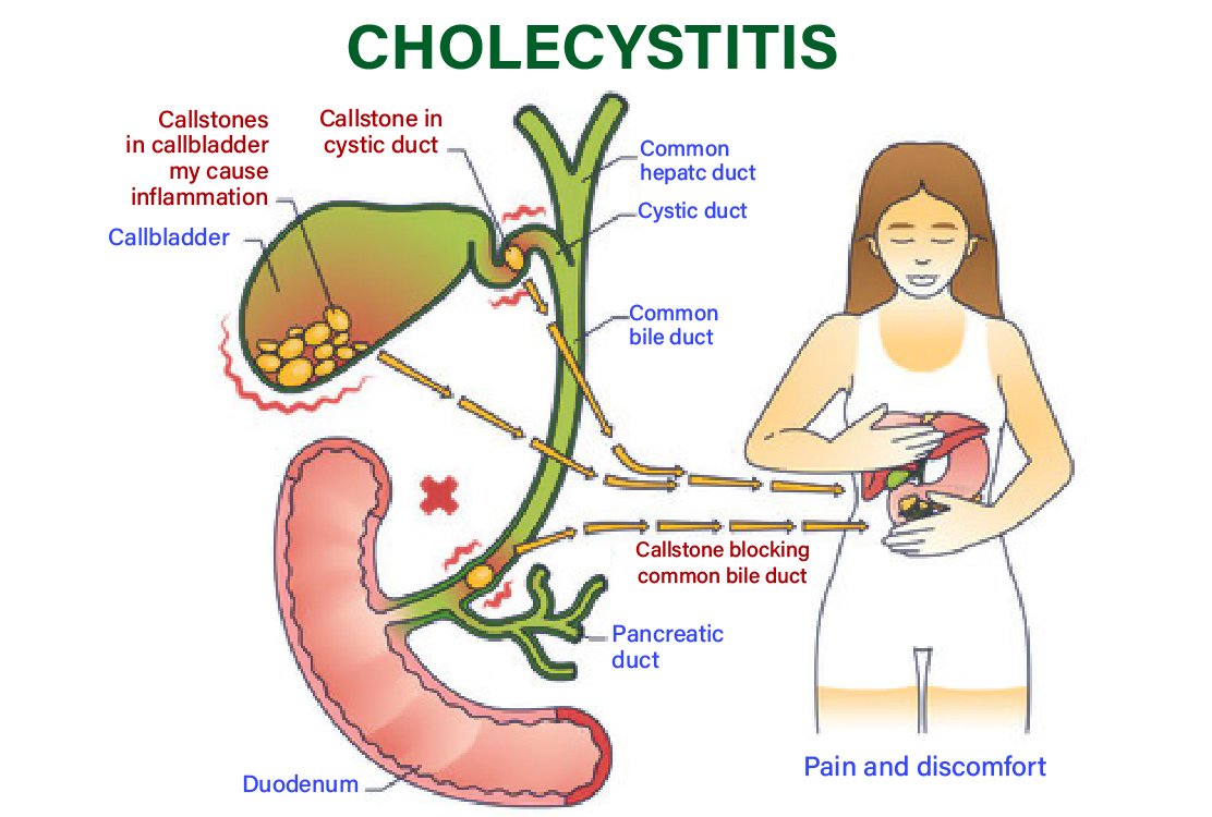 gallstones_for_gallbladder_removal_in_turkey