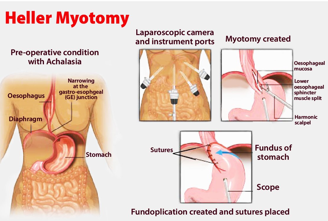 Heller-Myotomy-for-Esophageal-Surgery