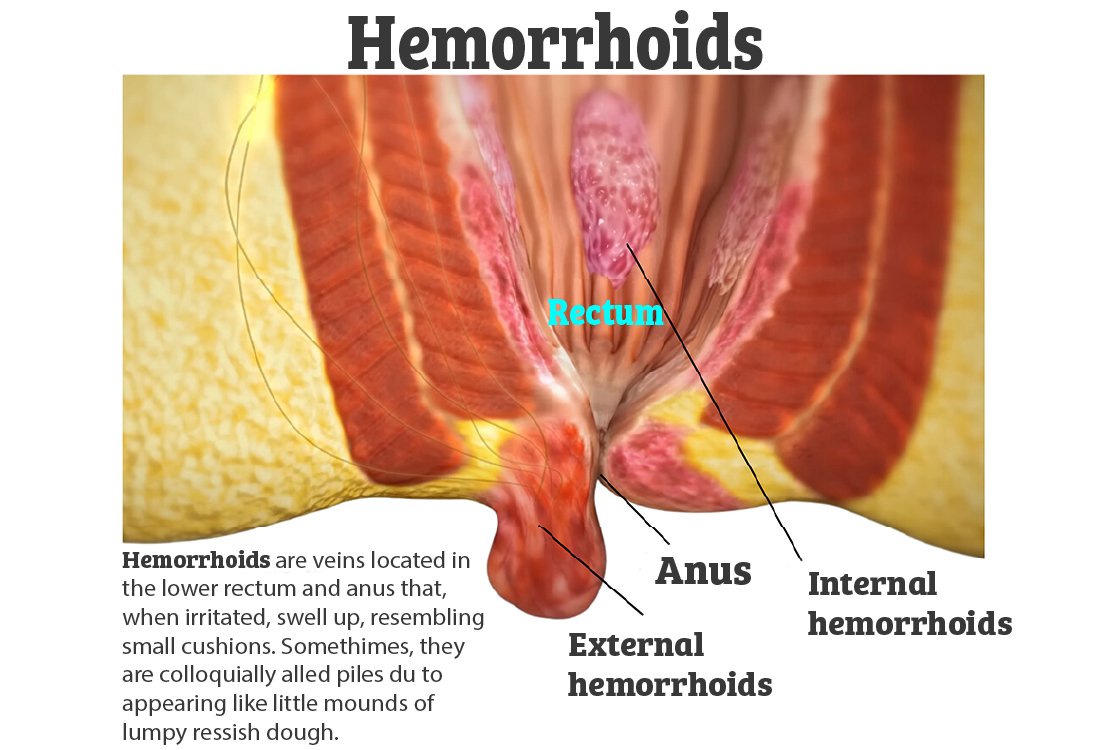 hemorrhoid_anatomy_for_hemorrhoidectomy_in_turkey