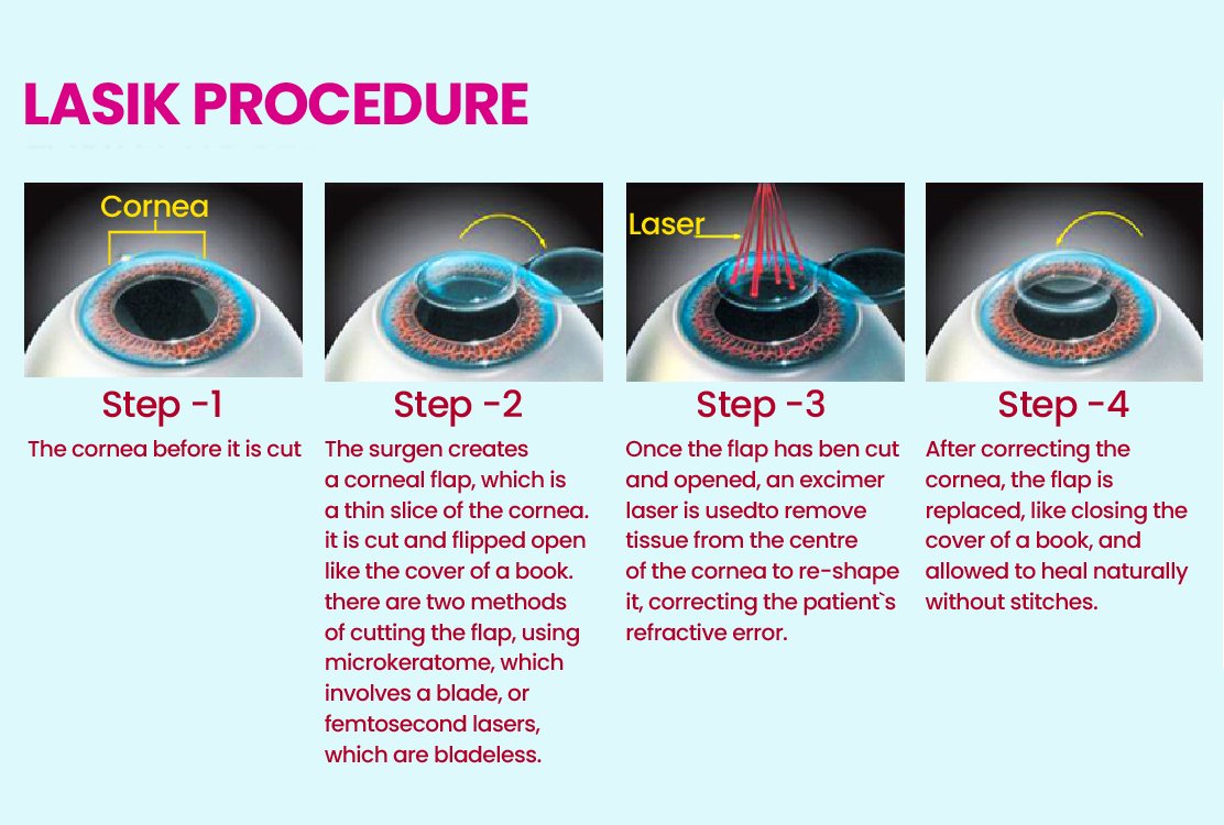 illustration_of_LASIK_laser_eye_treatment_in_turkey