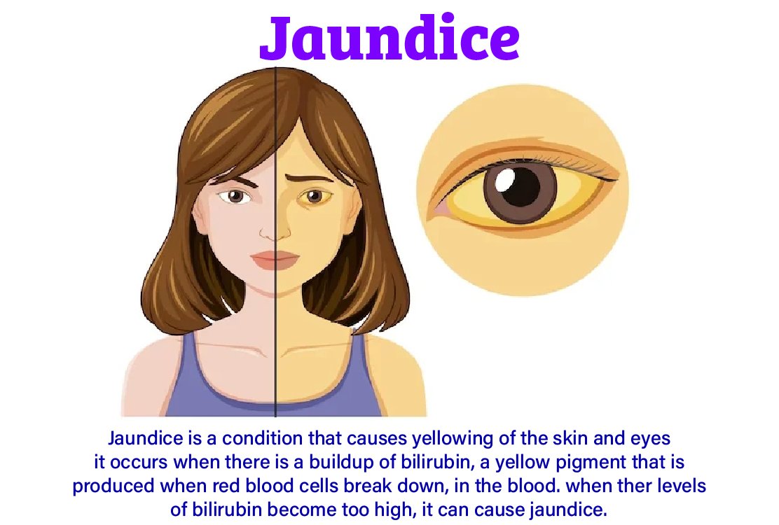 jaundice_for_gallbladder_removal_in_turkey