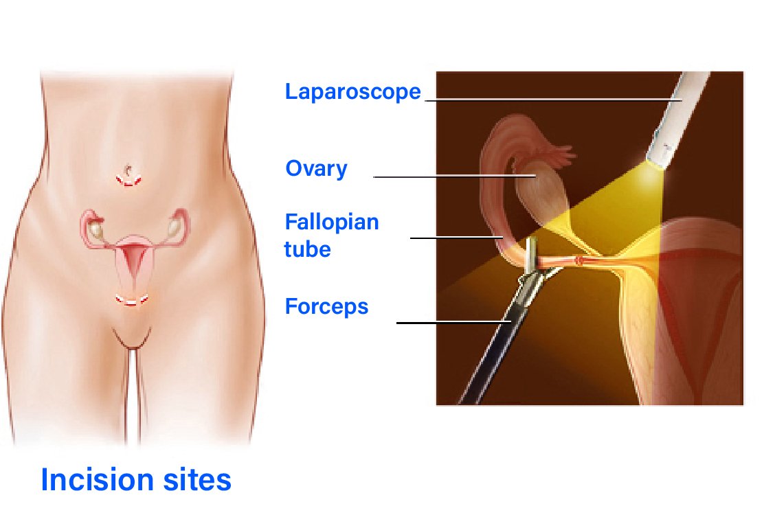Laparoscopic-Tubal-Ligation-in-Turkey