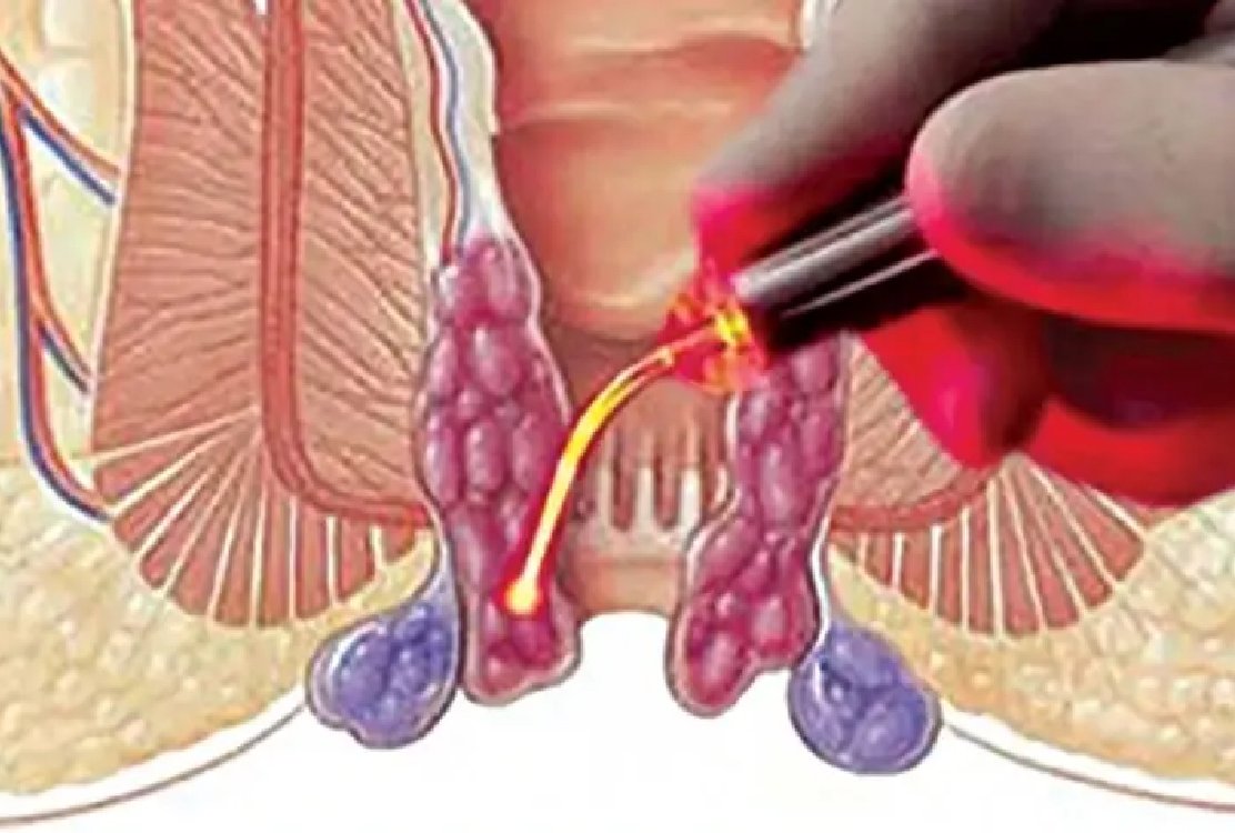 laser_hemorrhoidectomy_in_turkey
