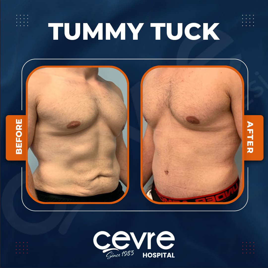 male_tummy_tuck_in_turkey_before_and_after_with_cevre (2)