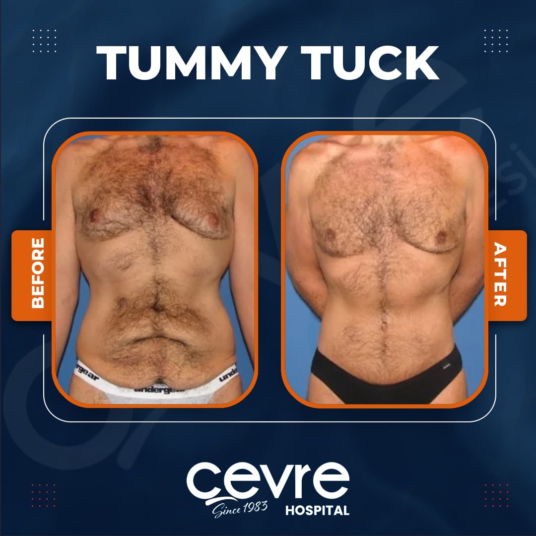male_tummy_tuck_in_turkey_before_and_after_with_cevre (3)