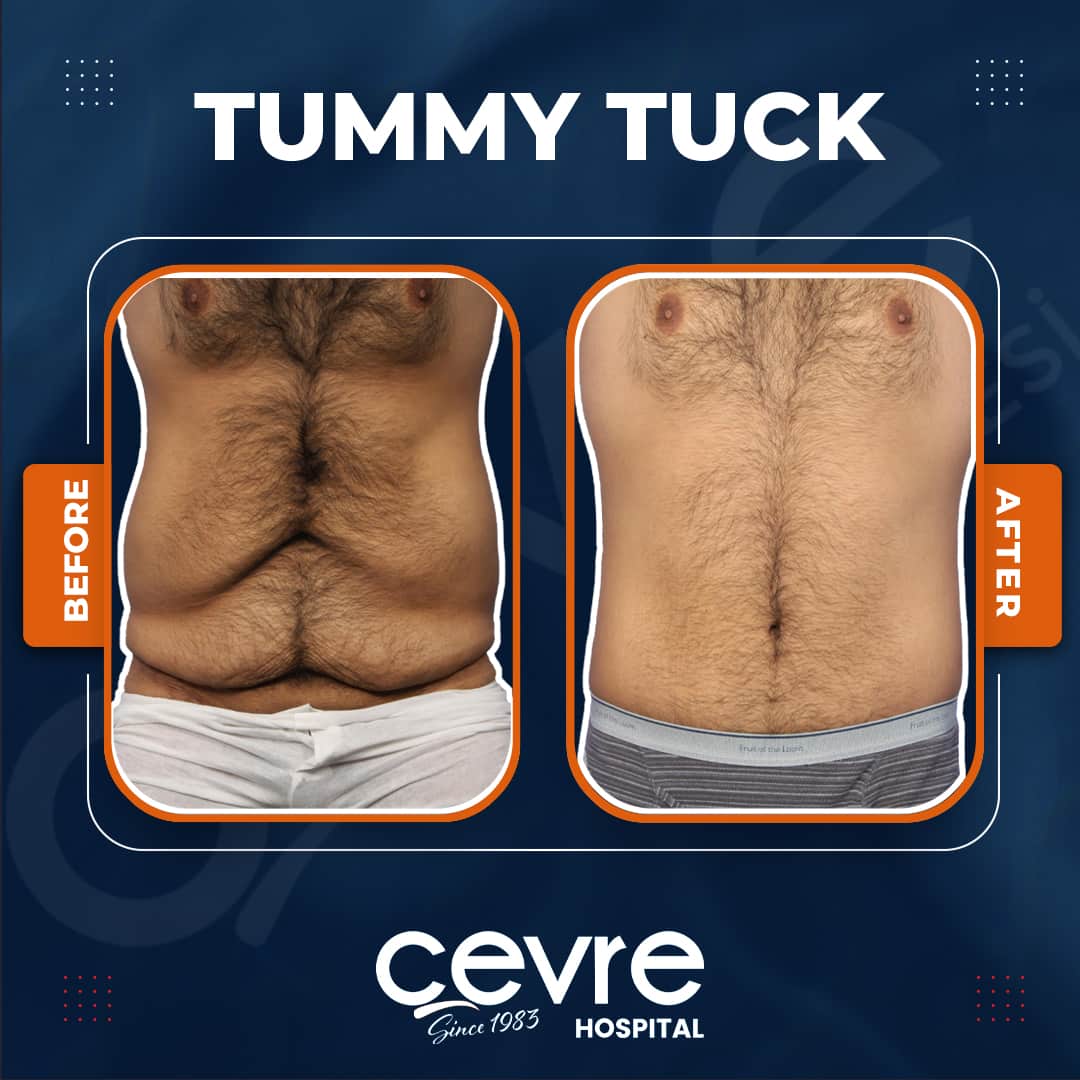 male_tummy_tuck_in_turkey_before_and_after_with_cevre (5)