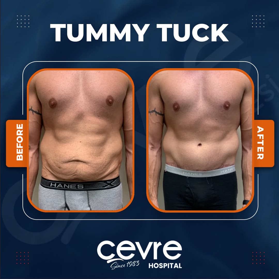 male_tummy_tuck_in_turkey_before_and_after_with_cevre