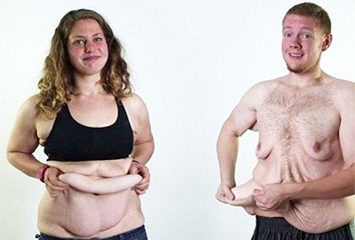 loose_skinman_and_woman_with_excess_skin_after_weightloss_for_body_sculpting_surgery_in_turkey_post_weight_loss_surgery_in_turkey