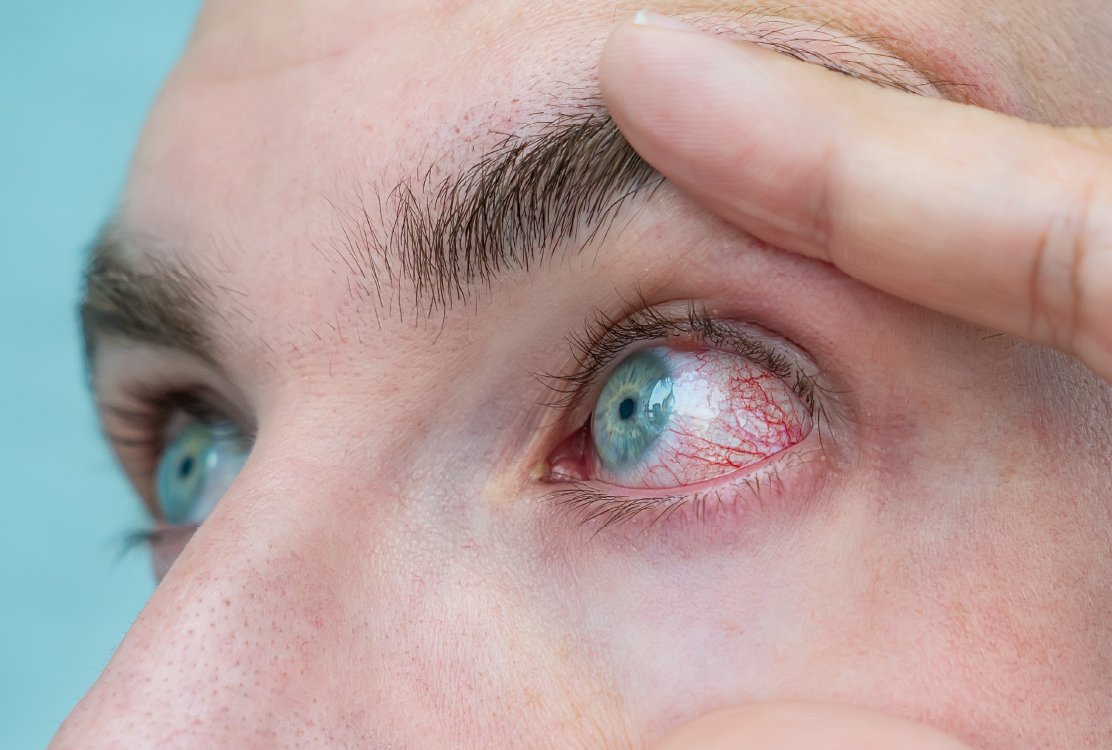 man_with_dry_eyes_after_eye_laser_treatment_in_turkey