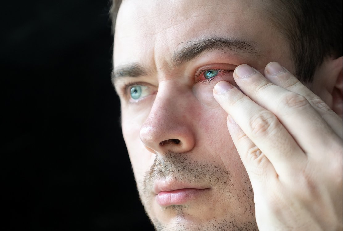 man_with_dry_eyes_before_laser_eye_treatment_in_turkey