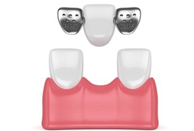 maryland_bridges_as_alternative_to_all_on_6_dental_implants_in_turkey