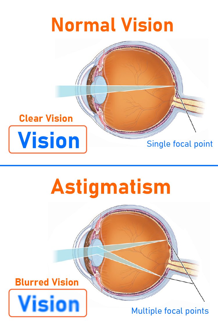 normal_vision_vs_astigmatism_for_laser_eye_treatment_in_turkey