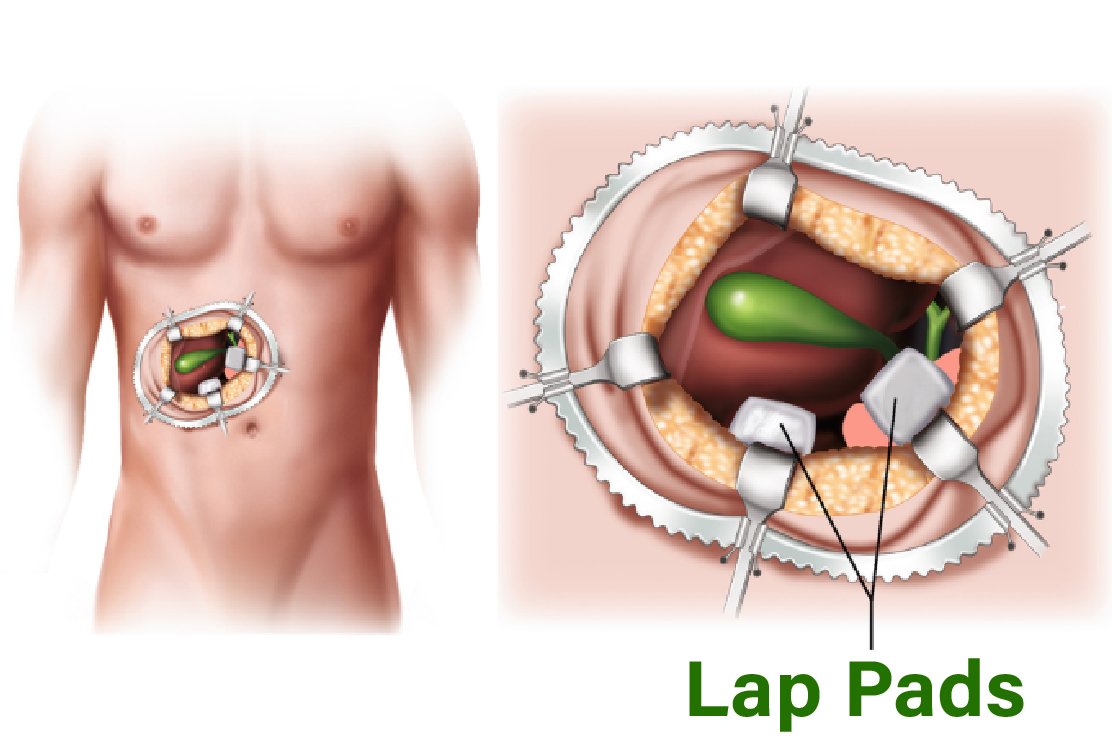 Open_Cholecystectomy_for_gallbladder_removal_in_turkey