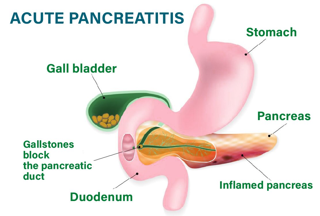 Pancreatitis_for _gallbladder_removal_in_turkey