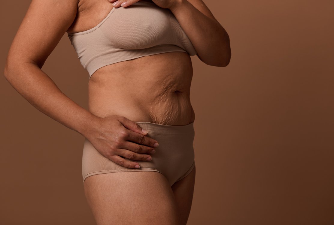 Postpartum-belly-for-tummy-tuck-with-muscle-reparation-in-turkey