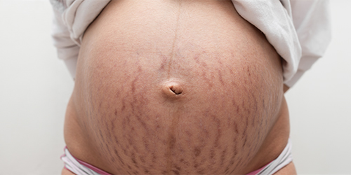 pregnant_woman_with_stretch_marks_for_mommy_makeover_in_turkey