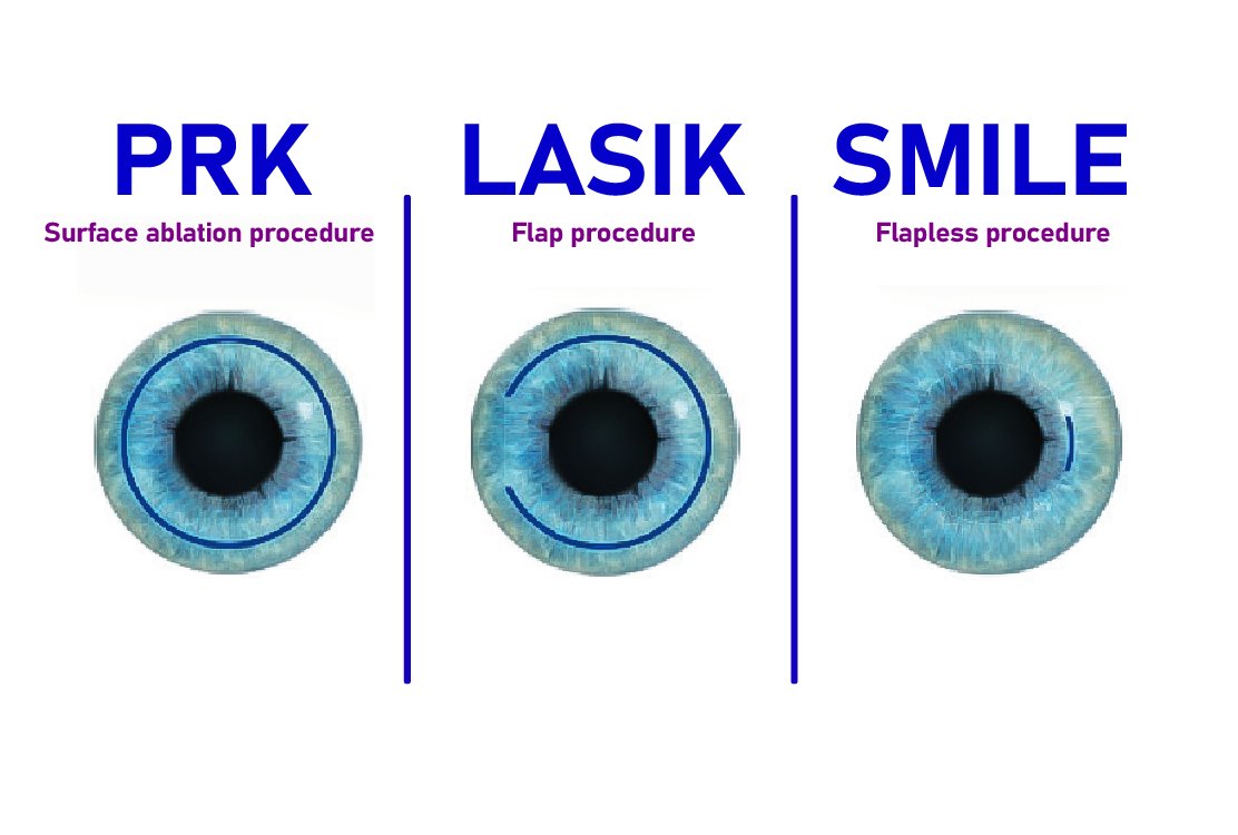 prk_vs_lasik_vs_smile_laser_eye_treatment_in_turkey