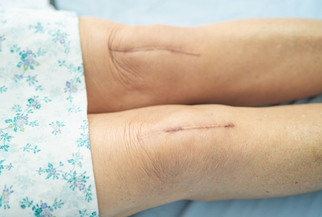 scar _on_knee_for_scar_revision_in_turkey