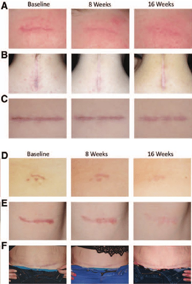 scar_healing_timeline_for_scar_revision_in_turkey