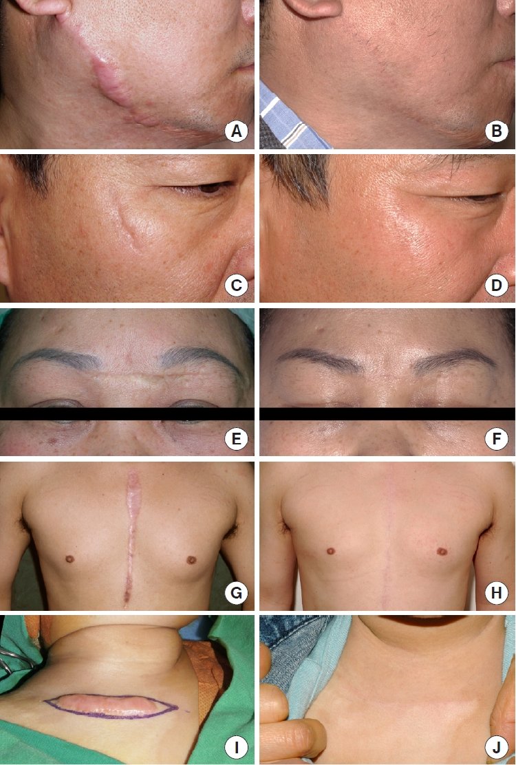 scar_revision_in_turkey_techniques