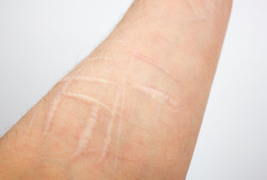 scars_for_scar_revision_in_turkey 
