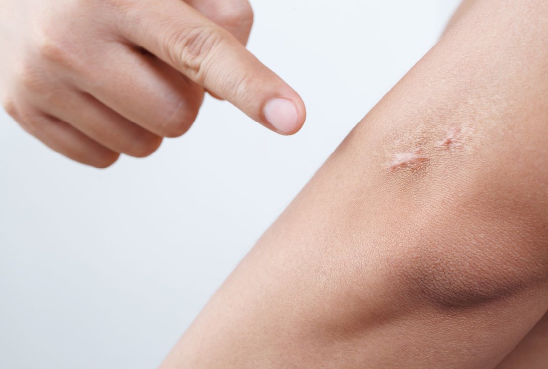 scars_for_scar_revision_in_turkey