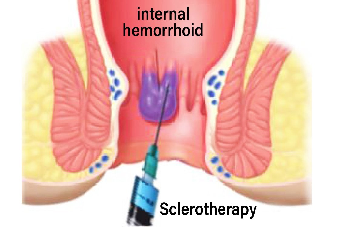 Sclerotherapy_for_hemorrhoidectomy_in_turkey