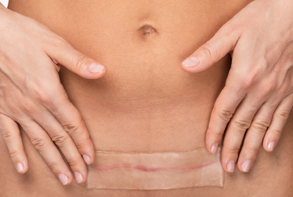 silicone_sheets_for_scar_revision_in_turkey