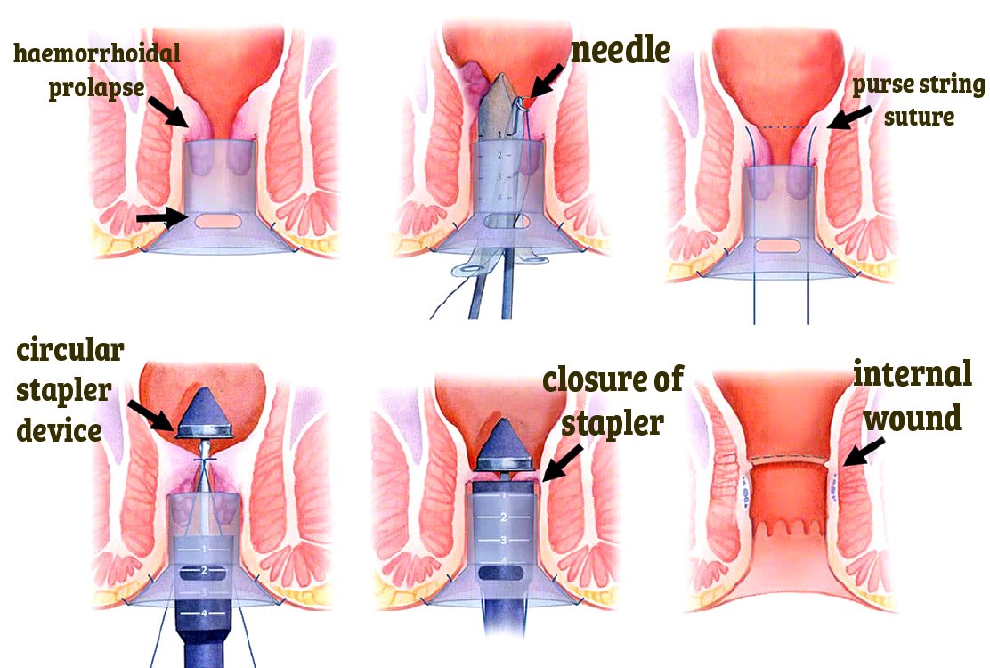 Stapled_Hemorrhoidopexy_hemorrhoidectomy_in_turkey