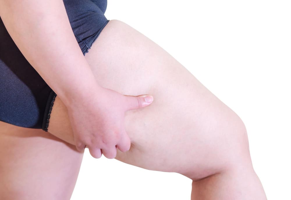 thigh_fat_before_liposuction_in_turkey