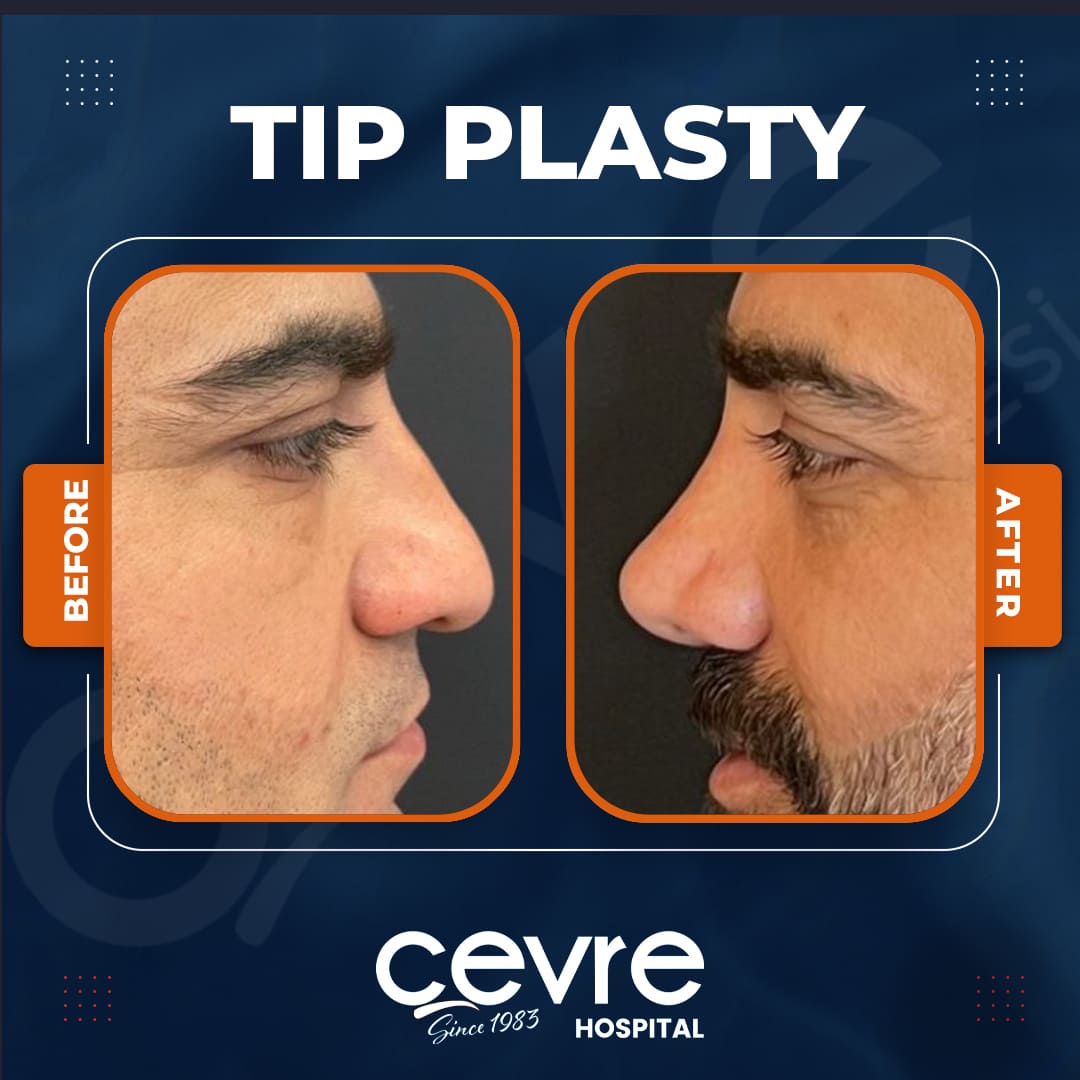 tip_plasty_in_turkey_before_and_after_photo (5)