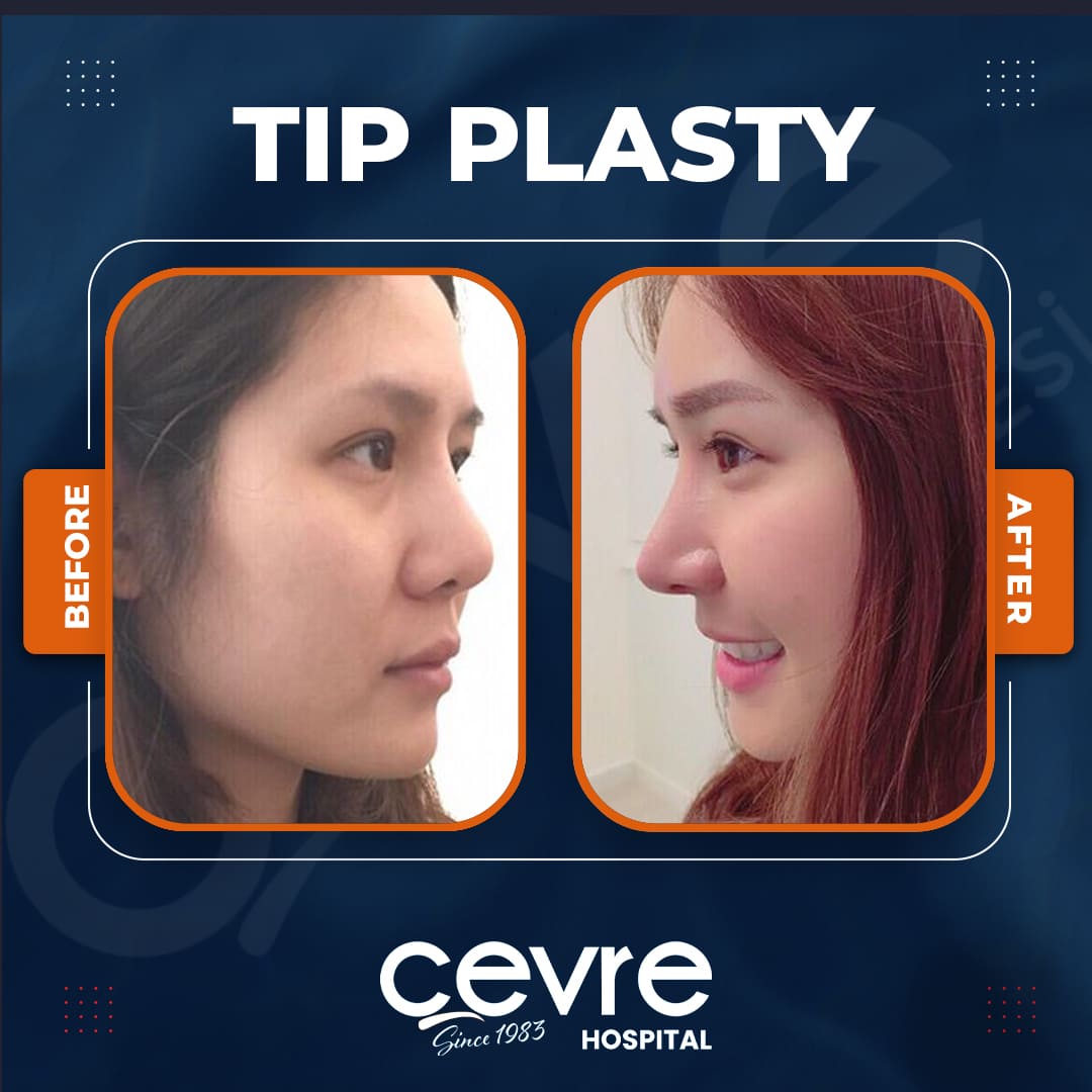 tip_plasty_in_turkey_before_and_after_photo
