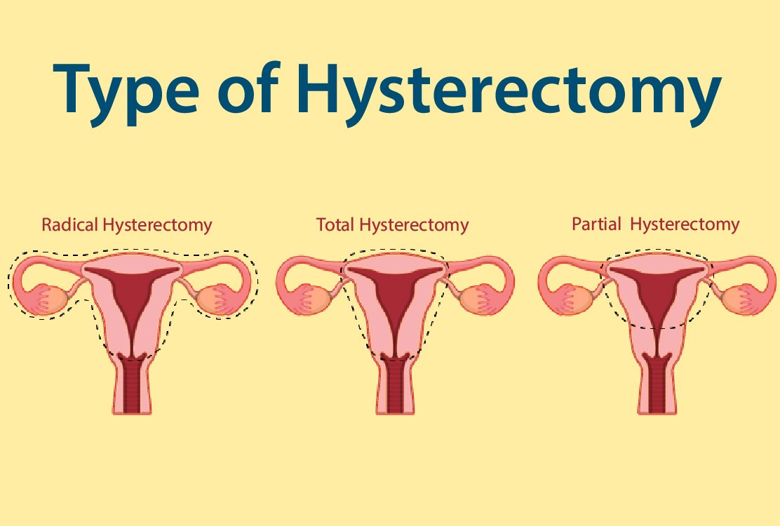 Types-of-Hysterectomy-in-Turkey