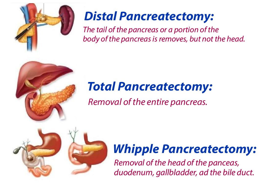 types-of-pancreatic-surgery-in-turkey
