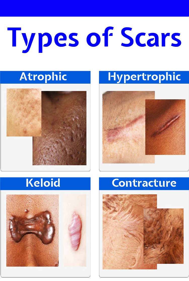 types_of_scars_for_scar_revision_in_turkey