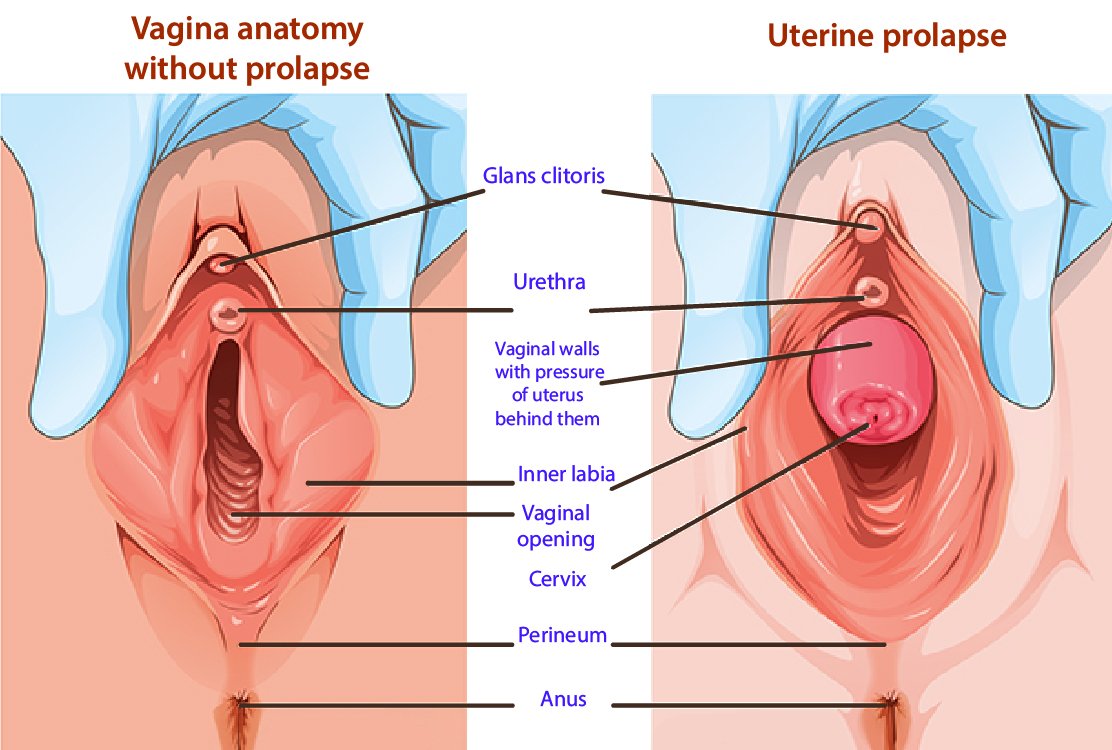 Uterine-prolapse-for-Hysterectomy-in-Turkey