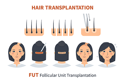 vector_illustrating_fut_hair_transplant_in_turkey