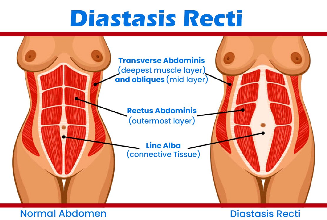 weakened-linea-alba-for-tummy-tuck-with-muscle-reparation-in-turkey