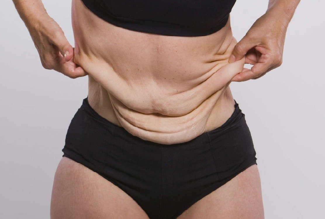 woman_with_excess_skin_for_body_contouring_post_weight_loss_in_turkey