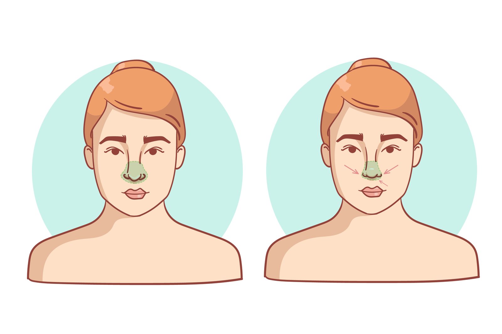 rinoplastinin avantajları